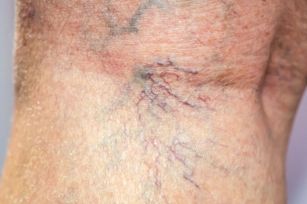 Varicose veins on the body