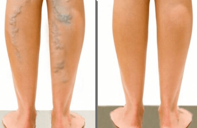 Varicose veins before and after the operation