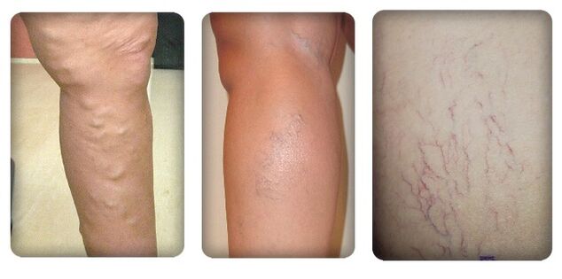 Stadiums of varicose veins