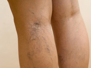 The second stage of the varicose veins