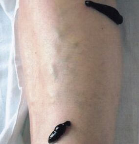 Hirudotherapy as a method for treating varicose veins