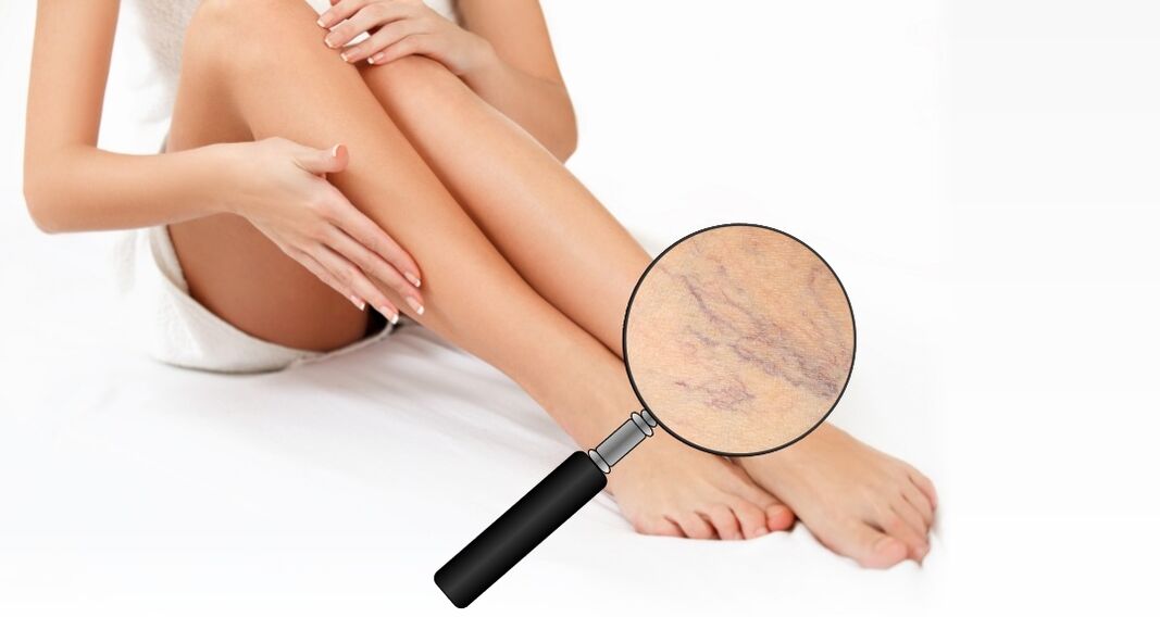 What do varicose veins look like