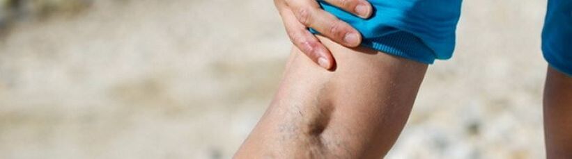 Varicose veins on the legs