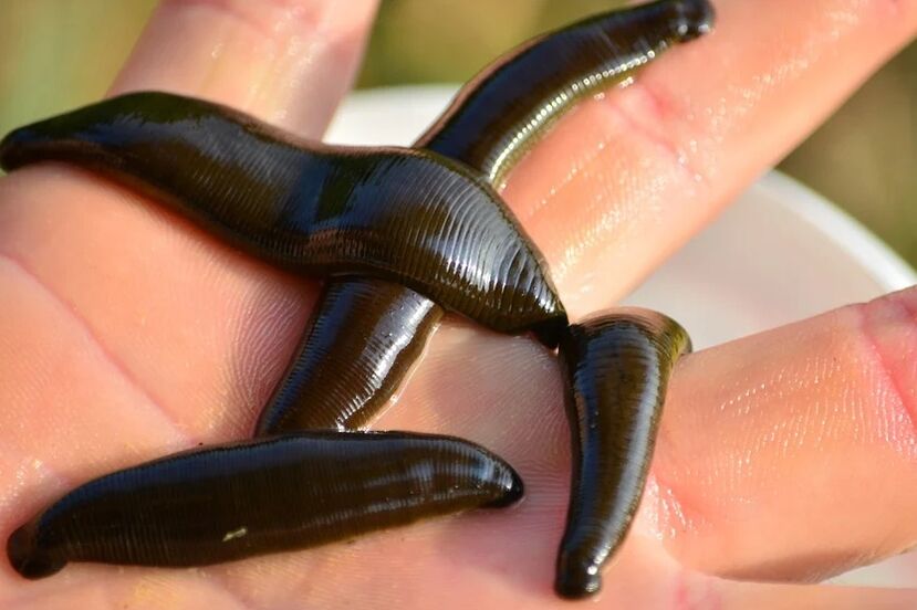 Leeches help fight varicose veins