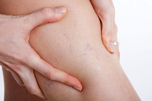 The first appearance of varicose veins on the leg