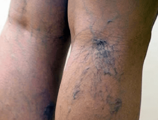 Varicose veins on the legs